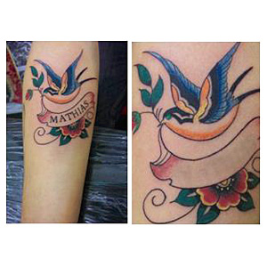 The Tattoo Removal Program